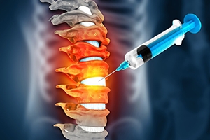 Everything You Need to Know About Spine Injections in Sterling