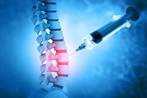 Spine Injections Sterling: A Non-Surgical Solution for Pain Relief