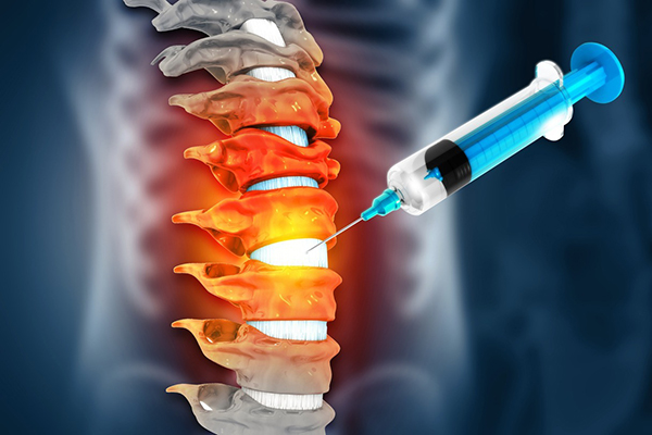 Everything You Need to Know About Spine Injections in Sterling